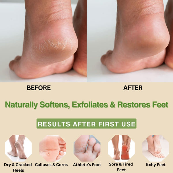Peppermint & Tea Tree Foot Cream | 5% Lactic Acid for Dry Cracked Heels Organic Skin Care